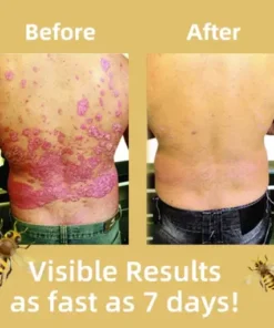 Cvreoz® Bee Venom Psoriasis Treatment Cream