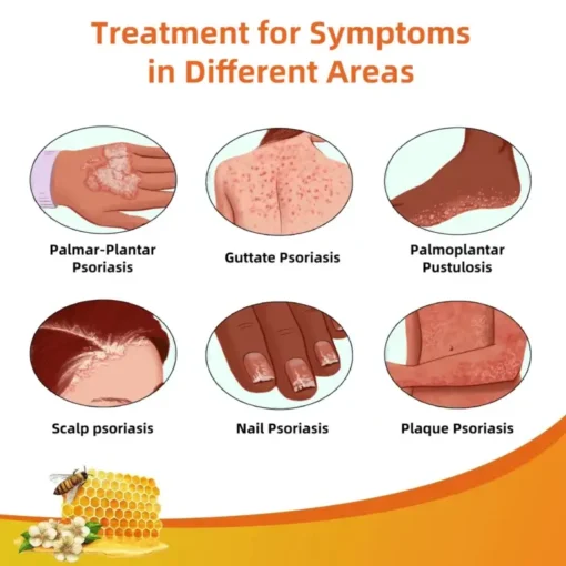 Cvreoz® Bee Venom Psoriasis Treatment Cream