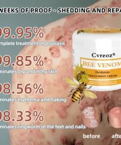 Cvreoz® Bee Venom Psoriasis Treatment Cream