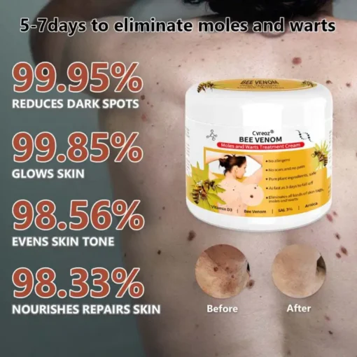 Cvreoz® PRO Bee Venom Mole and Wart Treatment Cream