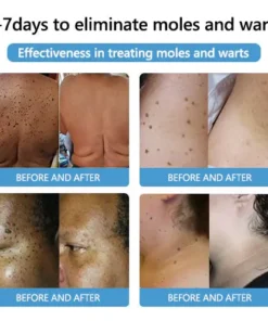 Cvreoz® PRO Bee Venom Mole and Wart Treatment Cream