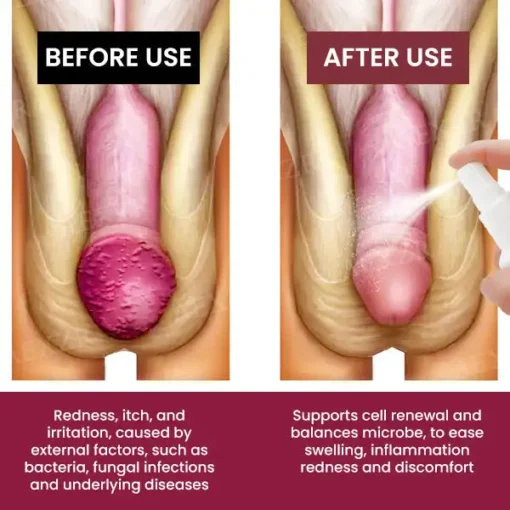 Cvreoz® Balanitis Treatment Spray
