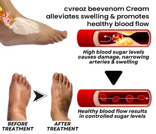 Cvreoz™ Bee Venom Diabetic Wounds Treatment Cream