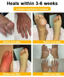 Cvreoz® Botulinum Toxin & Bee Venom Pain-Relief Bone Healing Cream