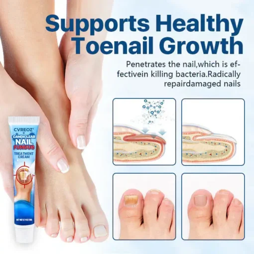 Cvreoz® Candiclear Nail Fungus Treatment Cream