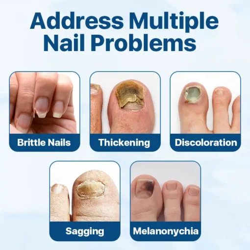 Cvreoz® Candiclear Nail Fungus Treatment Cream