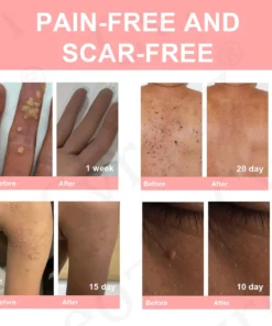 Cvreoz® Dual Acid Wart & Mole Removal Serum