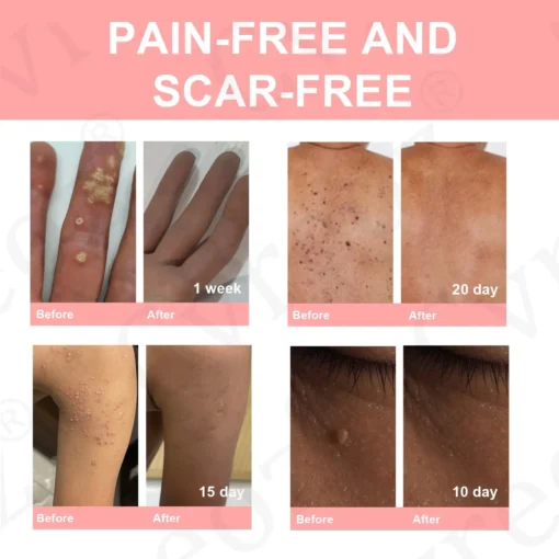 Cvreoz® Dual Acid Wart & Mole Removal Serum