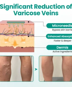 Cvreoz® LegRenew Varicose Veins Patch