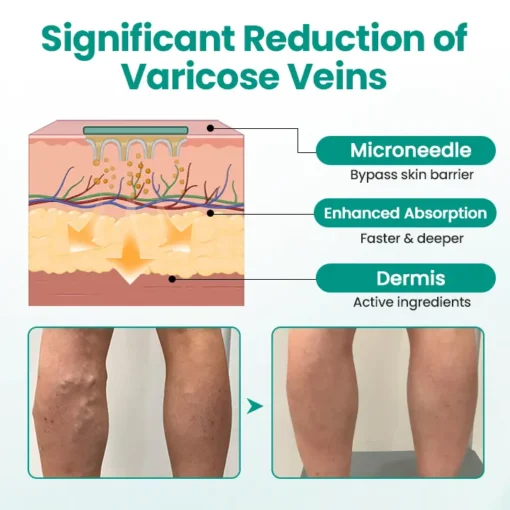 Cvreoz® LegRenew Varicose Veins Patch