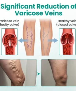 Cvreoz® LegRenew Varicose Veins Patch
