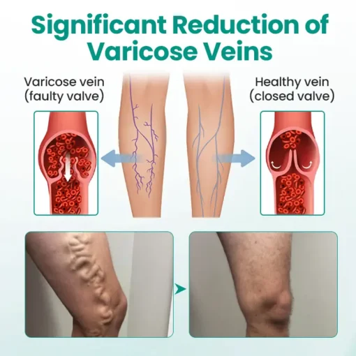 Cvreoz® LegRenew Varicose Veins Patch