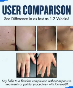 Cvreoz® Moles & Warts Removing Skin Tag Patch