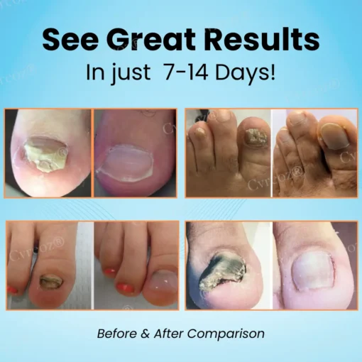 Cvreoz® Nail Strengthening Ointment