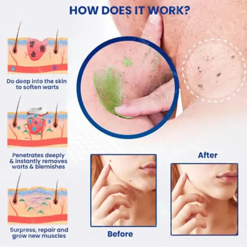 Cvreoz® NatureErase Instant Mole & Spot Cream