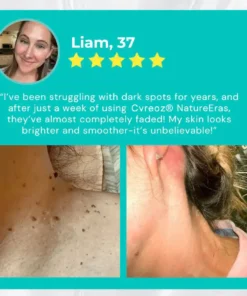 Cvreoz® NatureErase Instant Mole & Spot Cream