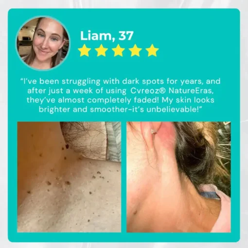 Cvreoz® NatureErase Instant Mole & Spot Cream