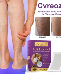 Cvreoz® Polidocanol Nano Patches for Varicose Veins