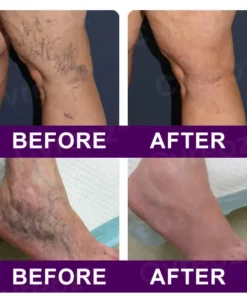 Cvreoz® Polidocanol Nano Patches for Varicose Veins