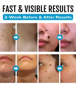 Cvreoz® SpotlessDerm Mole and Wart Laser Pen