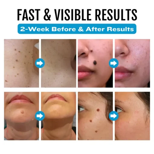 Cvreoz® SpotlessDerm Mole and Wart Laser Pen