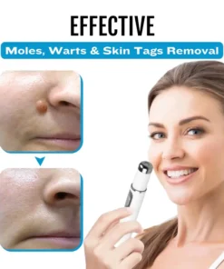 Cvreoz® SpotlessDerm Mole and Wart Laser Pen