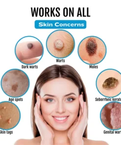 Cvreoz® SpotlessDerm Mole and Wart Laser Pen