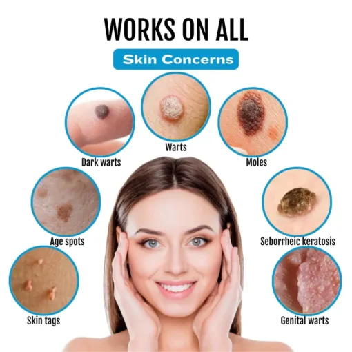 Cvreoz® SpotlessDerm Mole and Wart Laser Pen