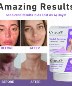 Cvreoz® Violet Eczema Treatment Cream