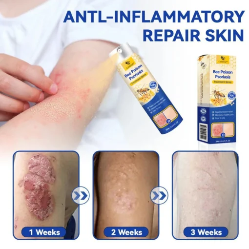 CVREOZ® Bee Poison Psoriasis Treatment Spray