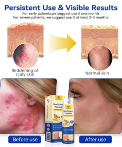 CVREOZ® Bee Poison Psoriasis Treatment Spray