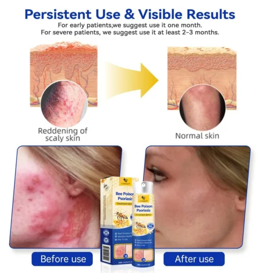 CVREOZ® Bee Poison Psoriasis Treatment Spray