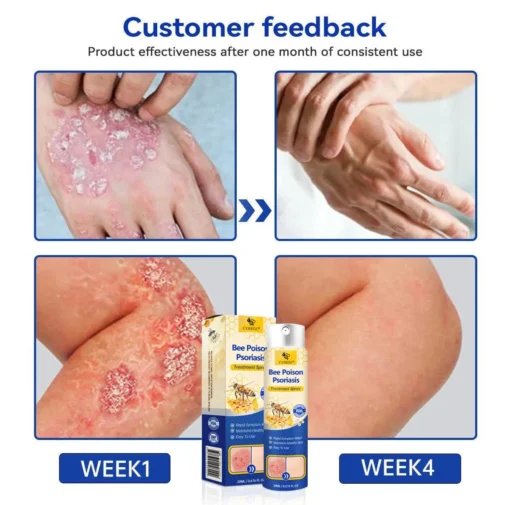 CVREOZ® Bee Poison Psoriasis Treatment Spray