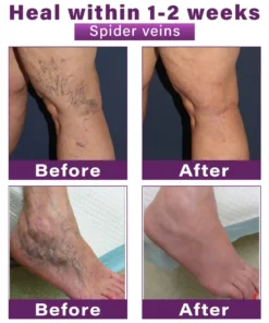 CVREOZ® Polidocanol Nano Varicose Vein Patch
