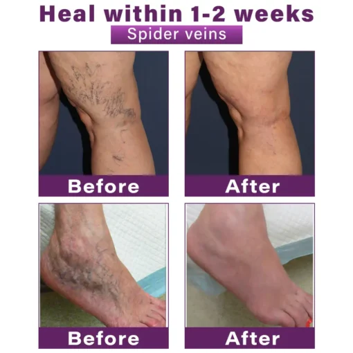 CVREOZ® Polidocanol Nano Varicose Vein Patch