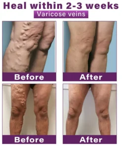 CVREOZ® Polidocanol Nano Varicose Vein Patch