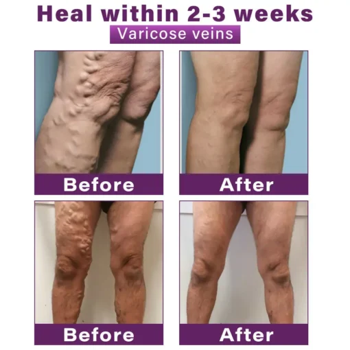 CVREOZ® Polidocanol Nano Varicose Vein Patch