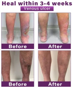 CVREOZ® Polidocanol Nano Varicose Vein Patch