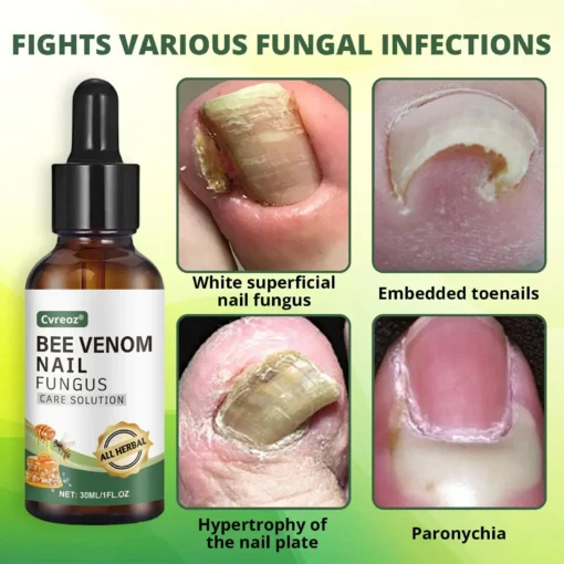 Cvreoz® Bee Venom Nail fungus care solution
