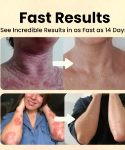 Cvreoz® Bee Venom Psoriasis Care Cream