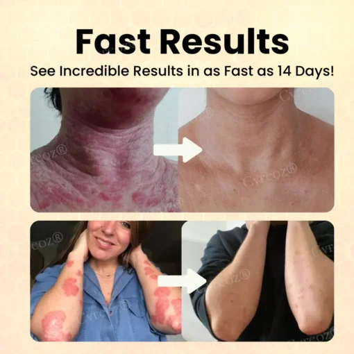 Cvreoz® Bee Venom Psoriasis Care Cream