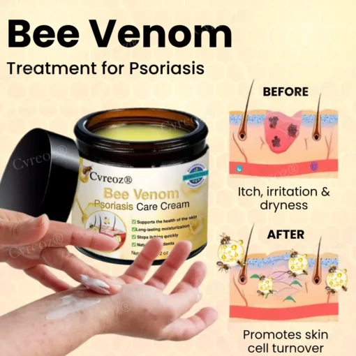 Cvreoz® Bee Venom Psoriasis Care Cream