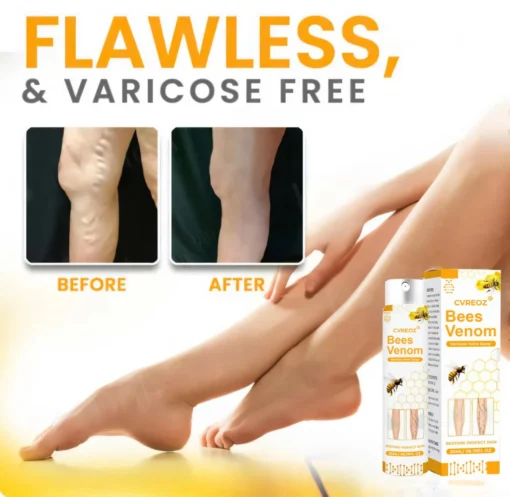 Cvreoz® Bees Venom Varicose Veins Spray