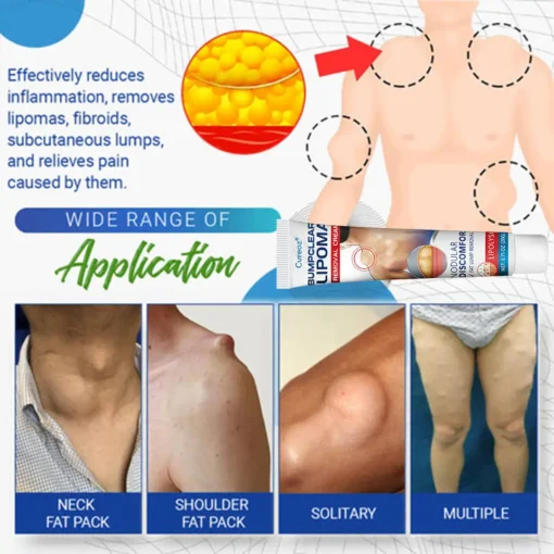 Cvreoz® BumpClear Lipoma Removal Cream
