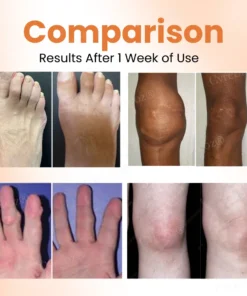 Cvreoz® Colchicine Nano-Needles Patches for Gout Care
