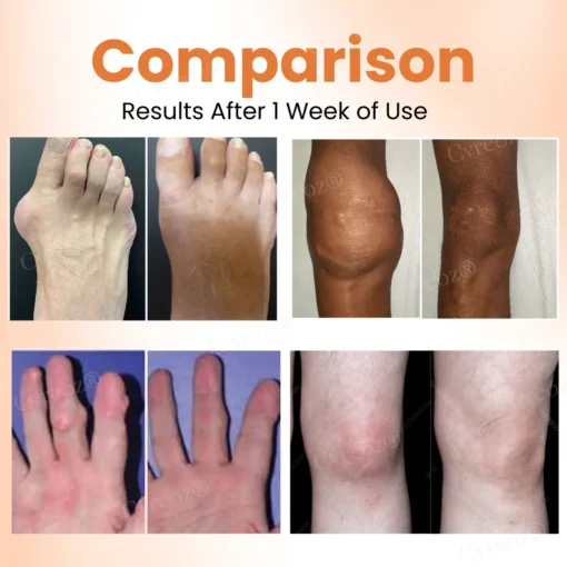 Cvreoz® Colchicine Nano-Needles Patches for Gout Care