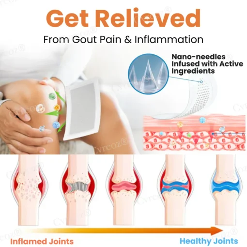 Cvreoz® Colchicine Nano-Needles Patches for Gout Care