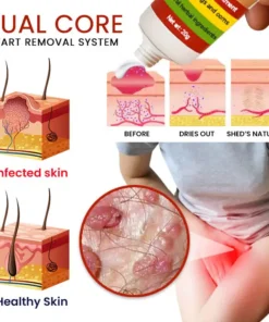 Cvreoz® FemGenital Wart Remover Cream