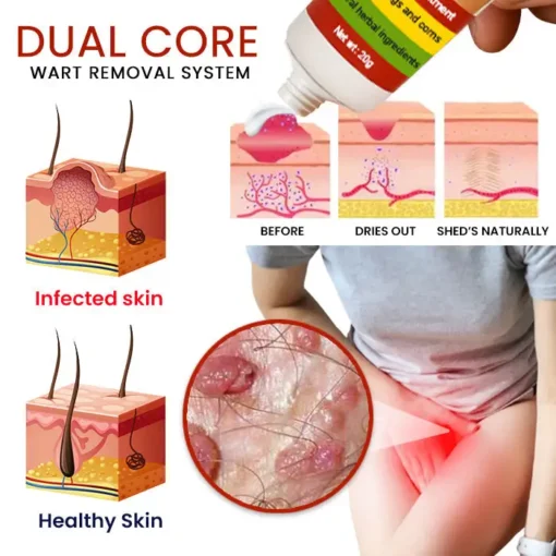 Cvreoz® FemGenital Wart Remover Cream