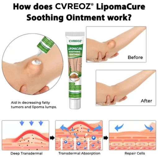 Cvreoz® LipomaCure Soothing Ointment